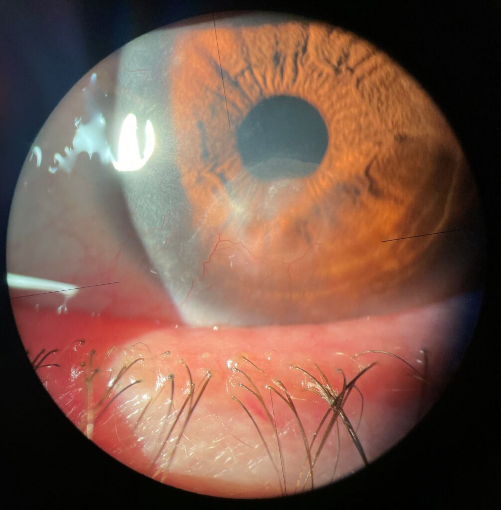 imagen de la córnea con Leucoma corneal vascularizado tras queratitis herpética