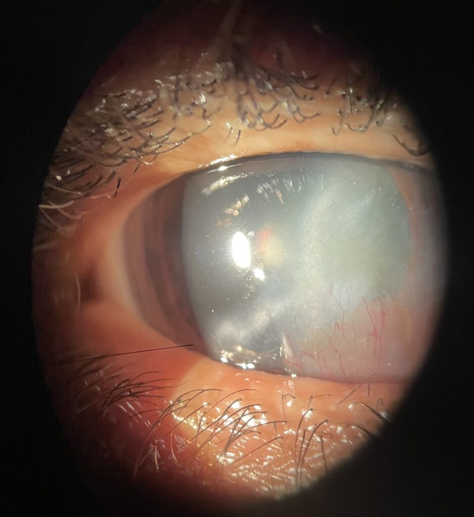 imagen de la córnea Leucoma corneal vascularizado.
