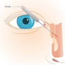 tratamiento-para-vías-lacrimales